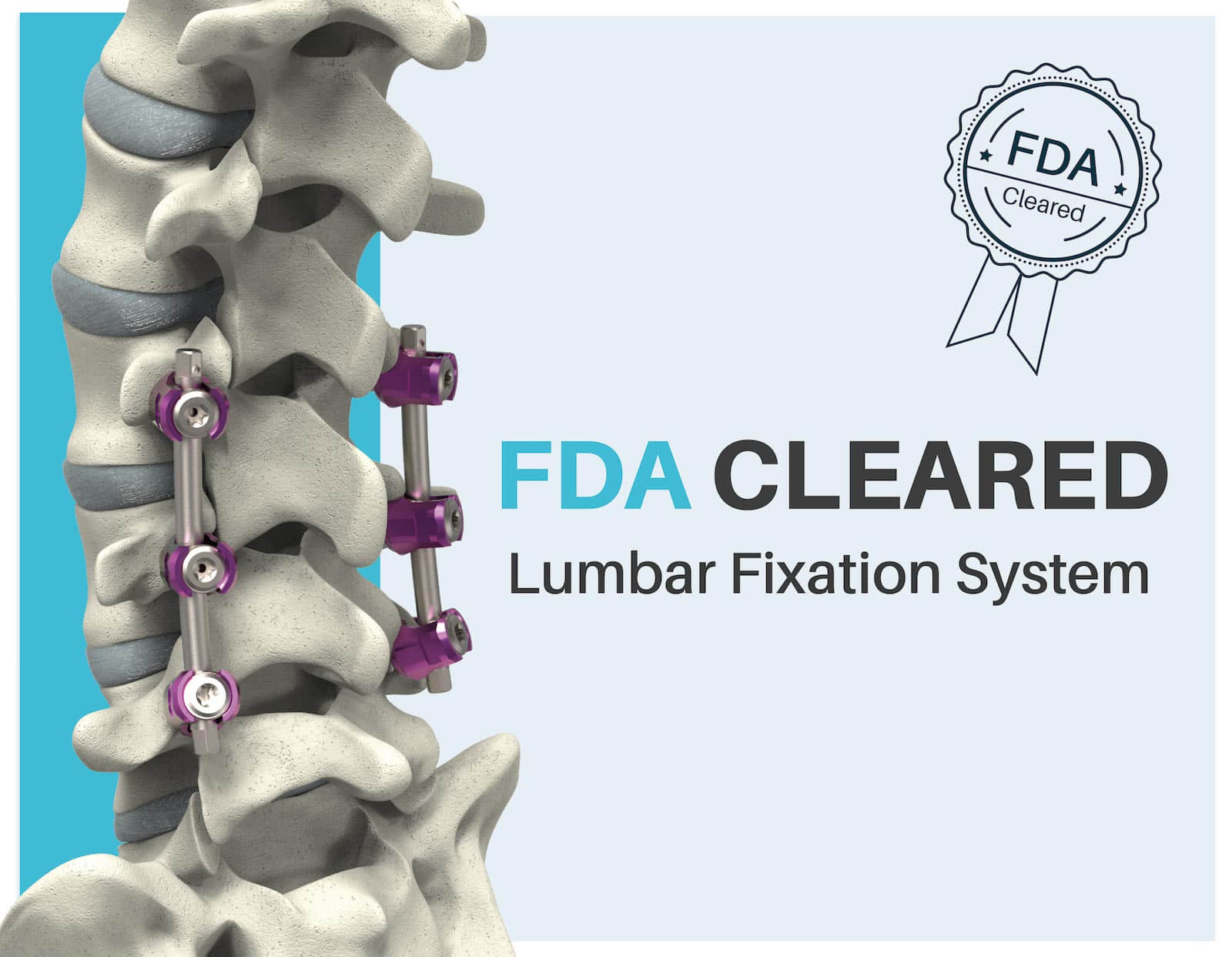FDA Approves Lumbar Fixation System