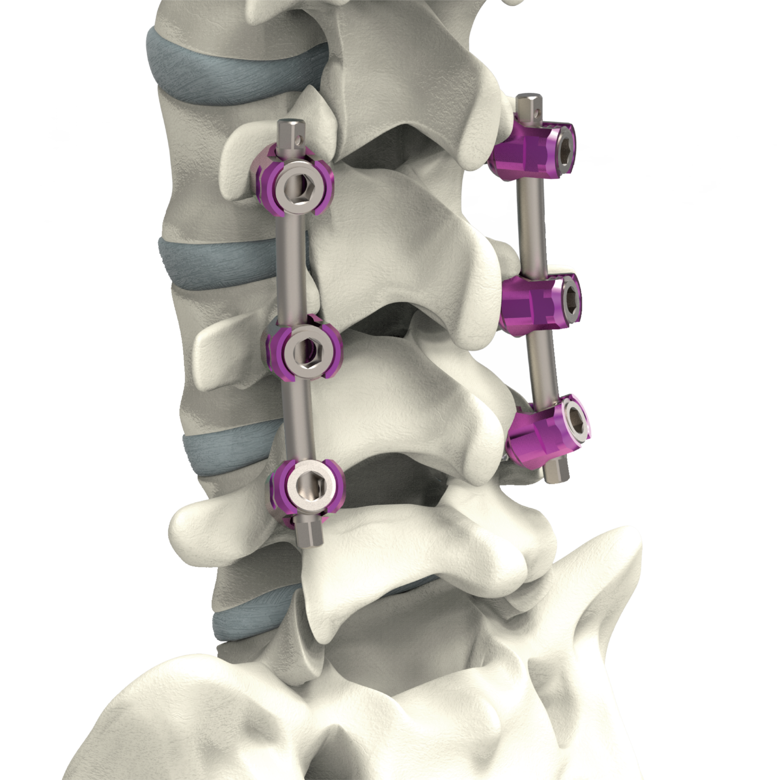 Lumbar Fixation System BAUI Biotech