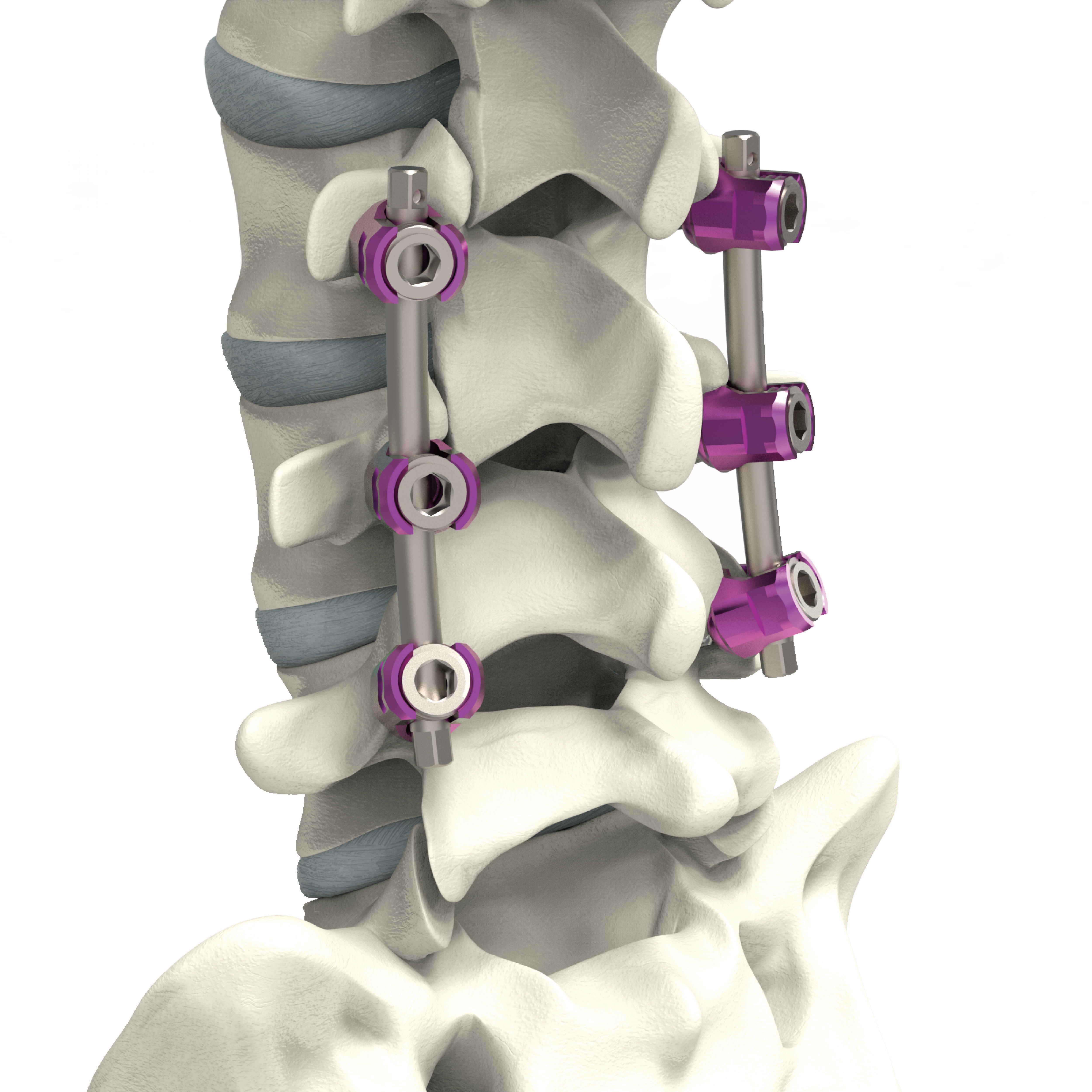Lumbar Fixation System | BAUI Biotech